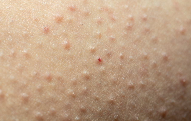 Фолликулярный кератоз у взрослых