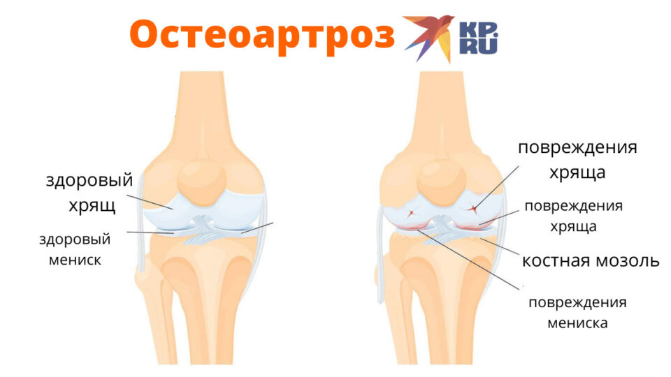 Остеоартроз