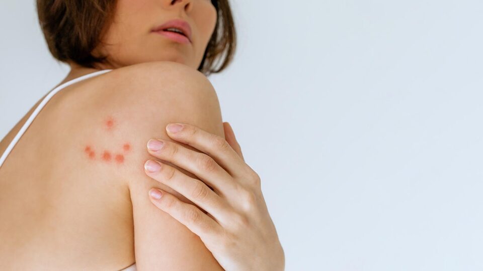 Следы от укусов. Фото: MarijaBazarova / Shutterstock / Fotodom